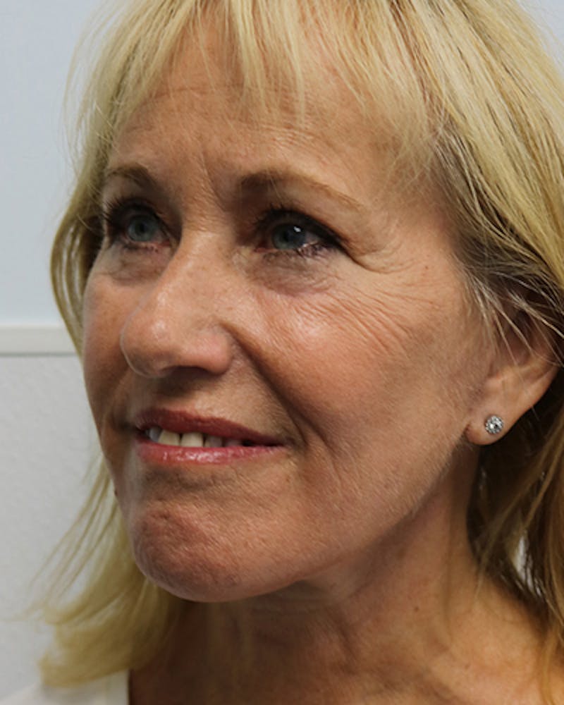 Facelift and Neck Lift Before & After Gallery - Patient 550518 - Image 4