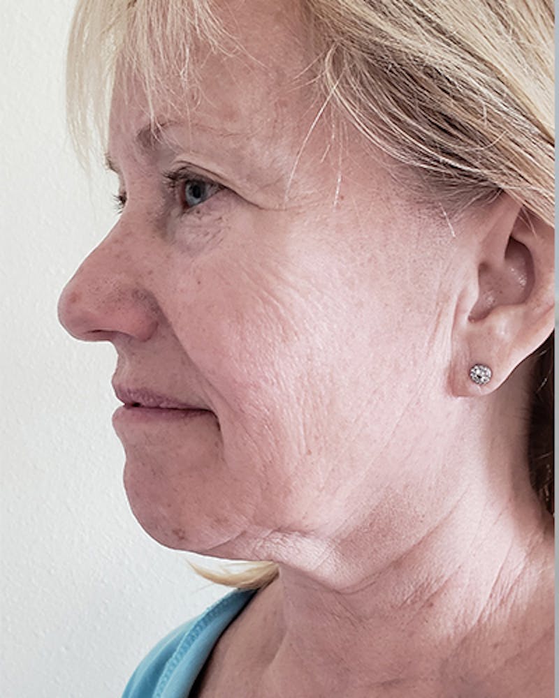 Facelift and Neck Lift Before & After Gallery - Patient 550518 - Image 5