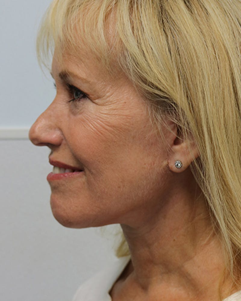 Facelift and Neck Lift Before & After Gallery - Patient 550518 - Image 6