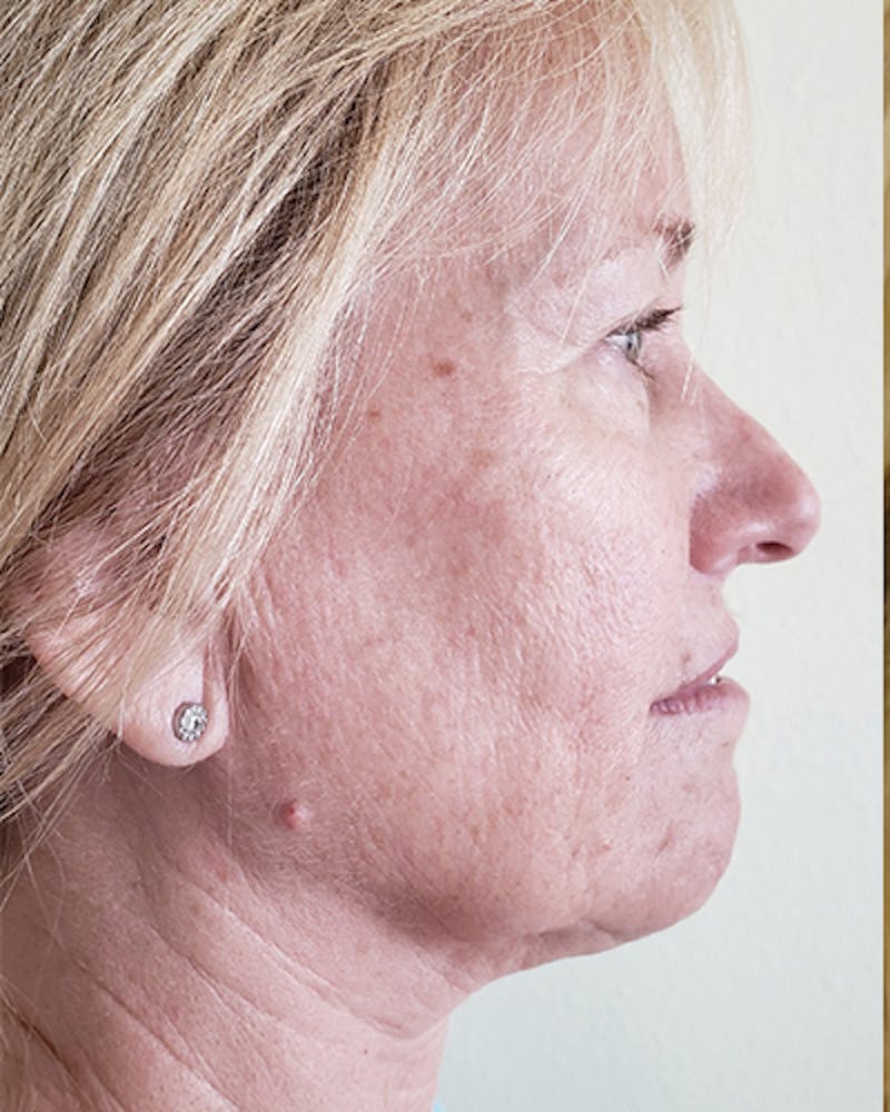 Facelift and Neck Lift Before & After Gallery - Patient 550518 - Image 7