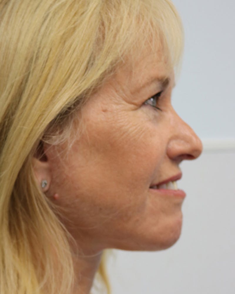 Facelift and Neck Lift Before & After Gallery - Patient 550518 - Image 8