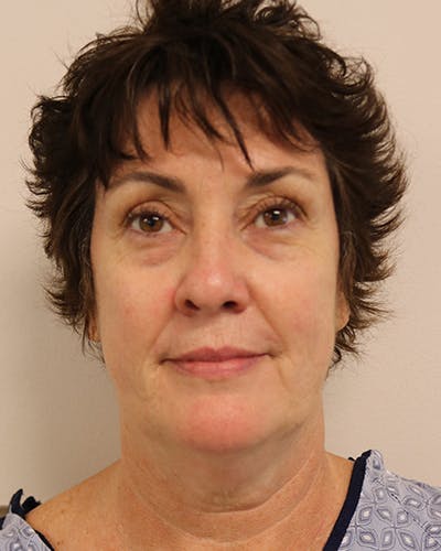 Facelift and Neck Lift Before & After Gallery - Patient 249884 - Image 1