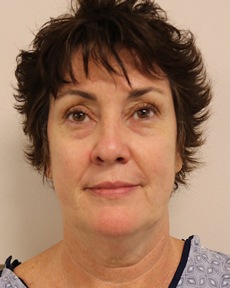 Facelift and Neck Lift Before & After Gallery - Patient 249884 - Image 1