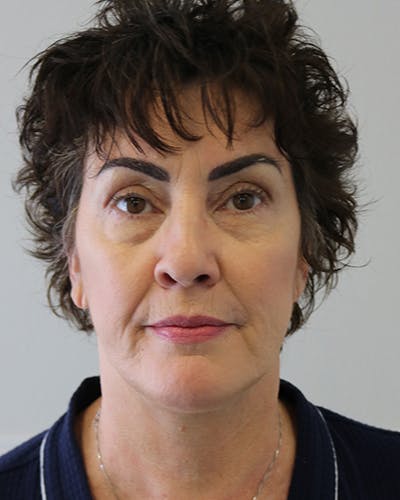 Facelift and Neck Lift Before & After Gallery - Patient 249884 - Image 2