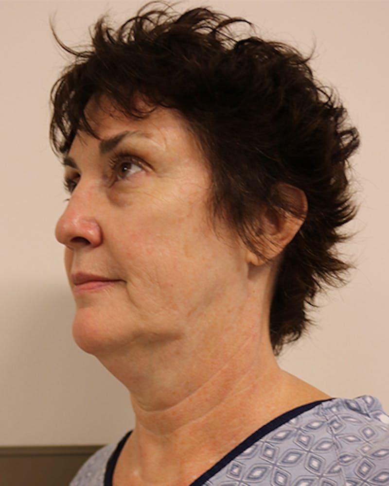 Facelift and Neck Lift Before & After Gallery - Patient 249884 - Image 3