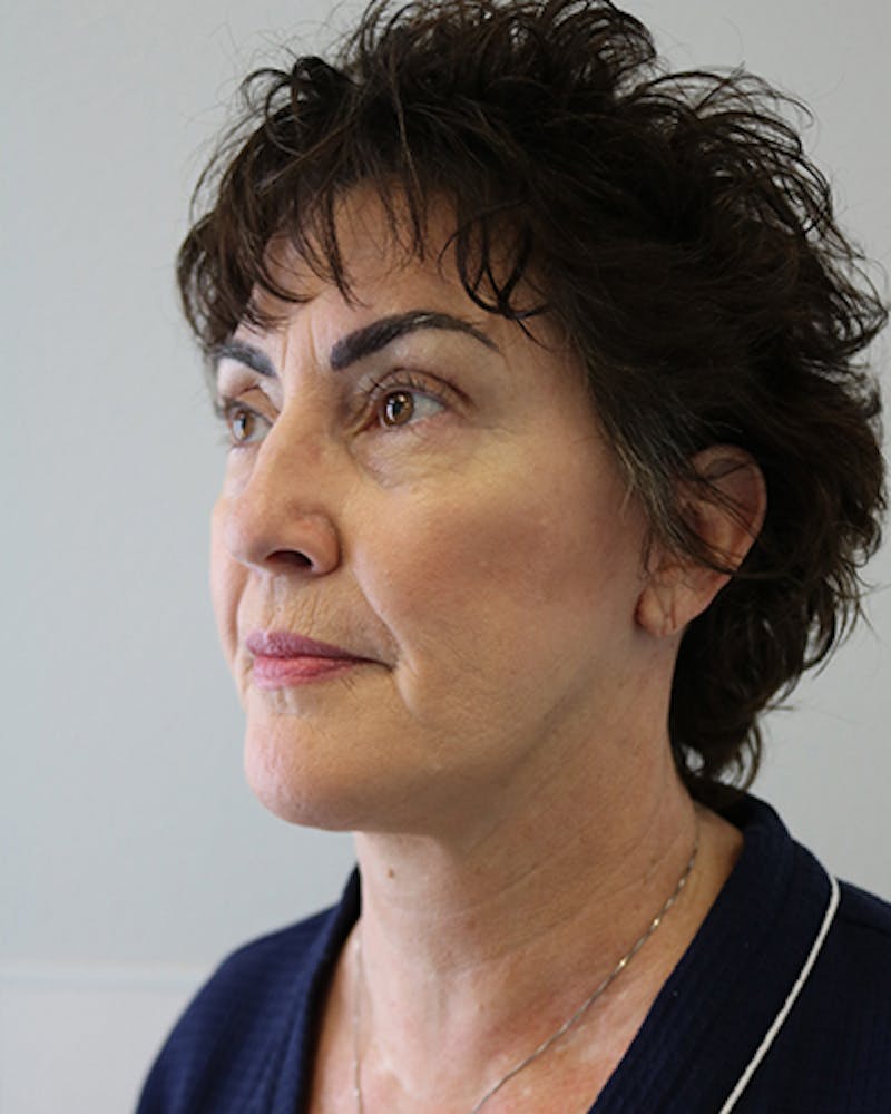 Facelift and Neck Lift Before & After Gallery - Patient 249884 - Image 4