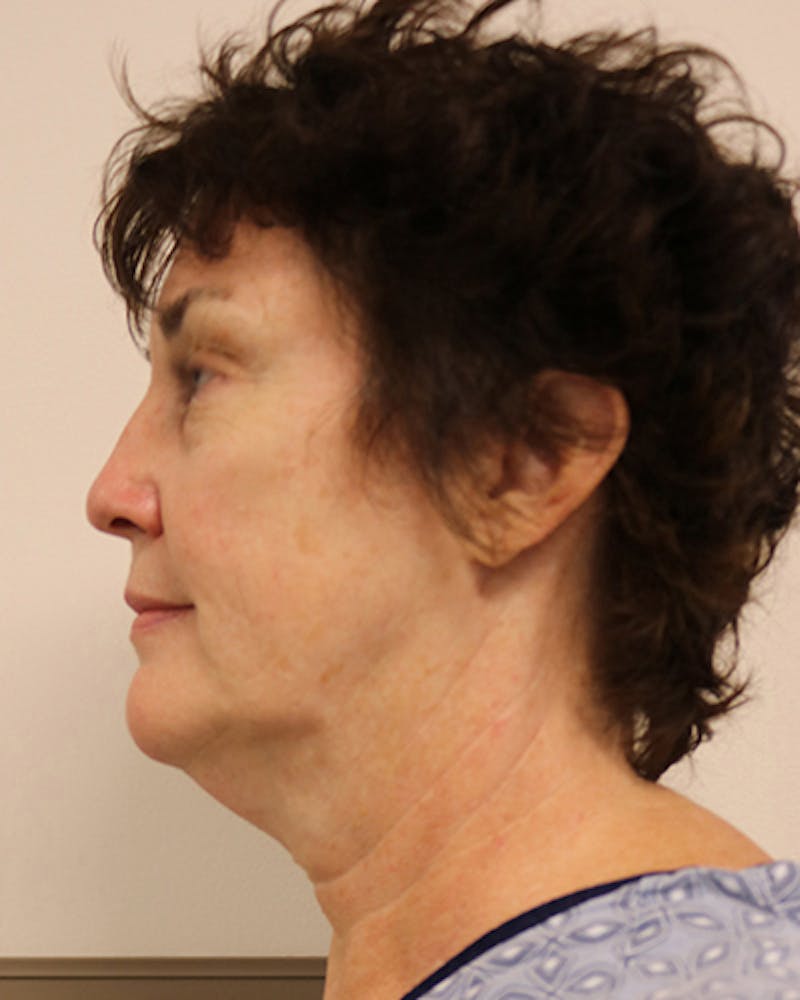 Facelift and Neck Lift Before & After Gallery - Patient 249884 - Image 5