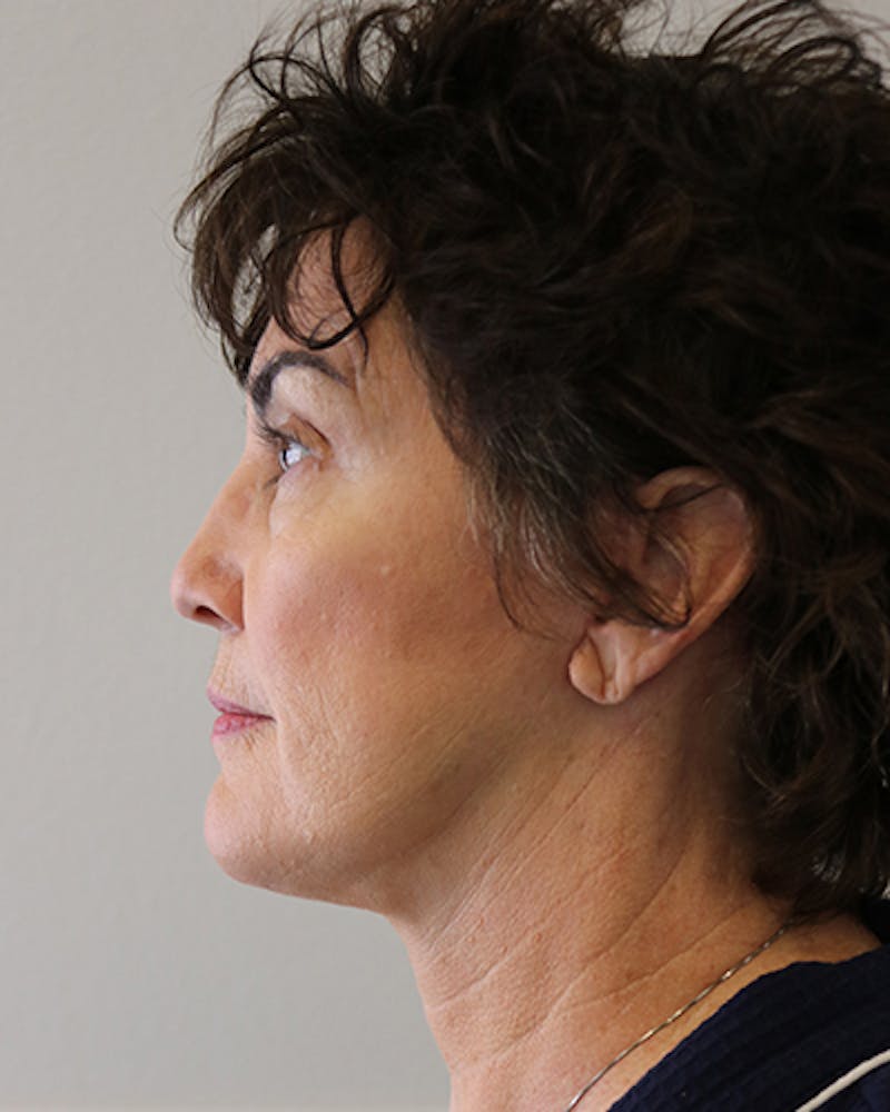 Facelift and Neck Lift Before & After Gallery - Patient 249884 - Image 6