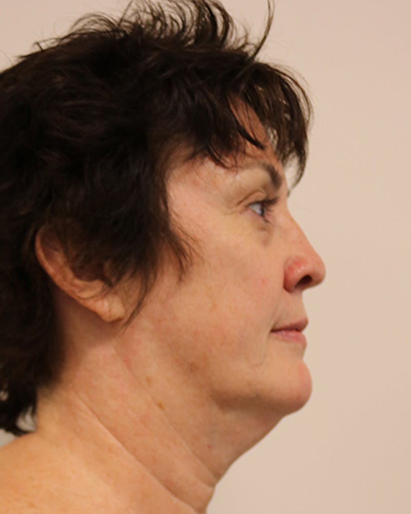 Facelift and Neck Lift Before & After Gallery - Patient 249884 - Image 7