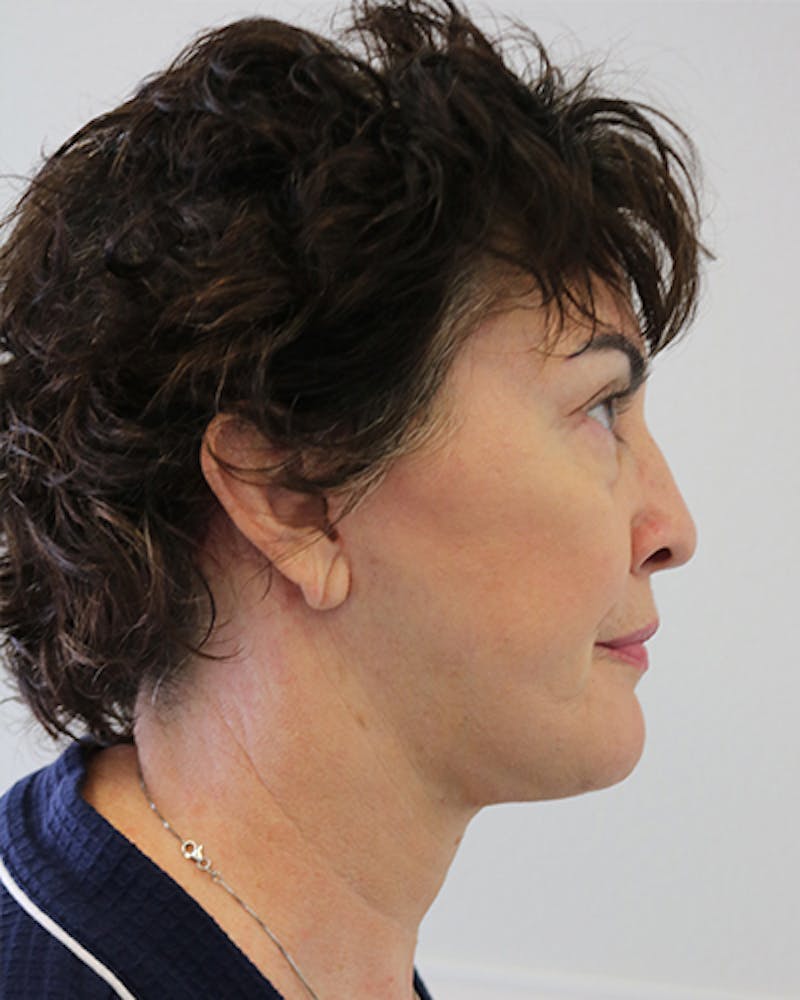 Facelift and Neck Lift Before & After Gallery - Patient 249884 - Image 8