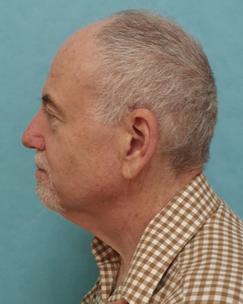 Facelift and Neck Lift Before & After Gallery - Patient 216576 - Image 3
