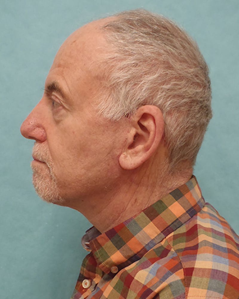 Facelift and Neck Lift Before & After Gallery - Patient 216576 - Image 4