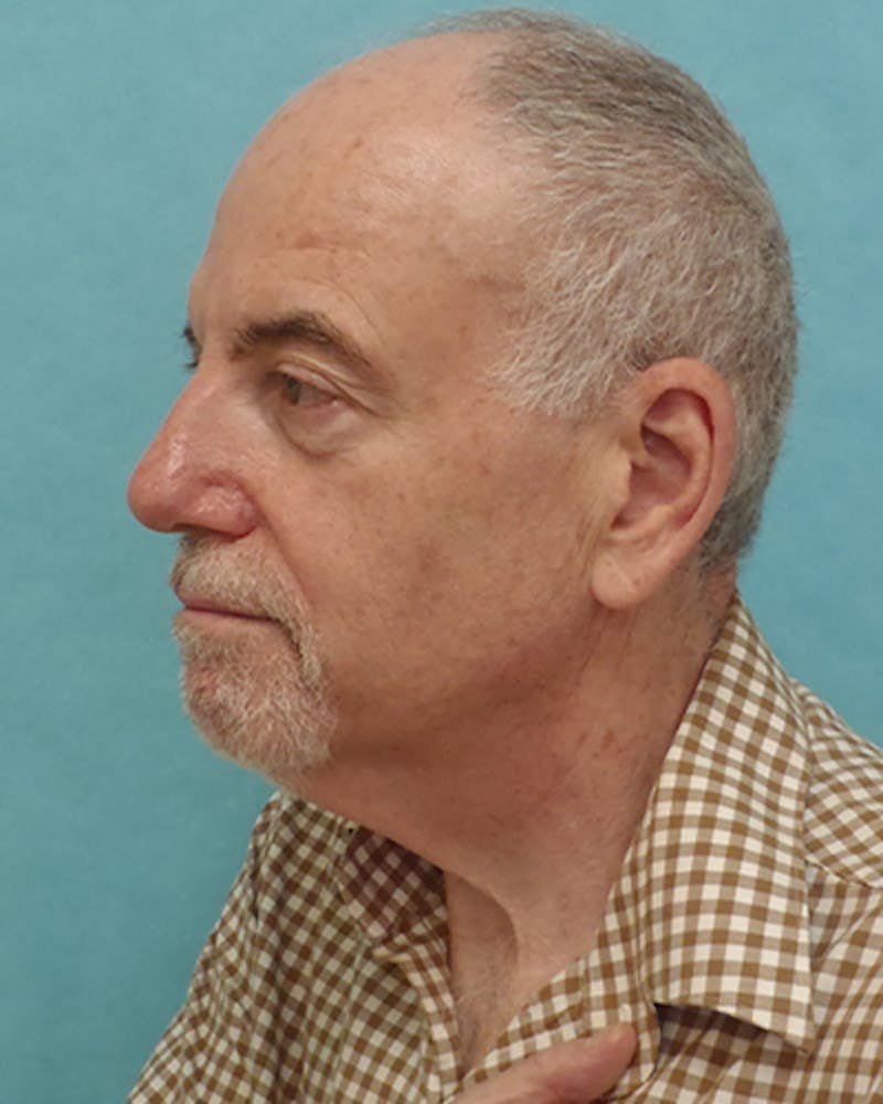 Facelift and Neck Lift Before & After Gallery - Patient 216576 - Image 5