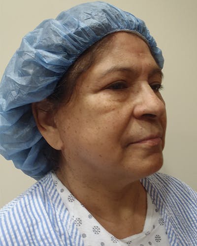Facelift and Neck Lift Before & After Gallery - Patient 249740 - Image 1