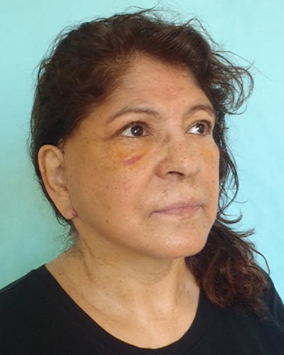 Facelift and Neck Lift Before & After Gallery - Patient 249740 - Image 2