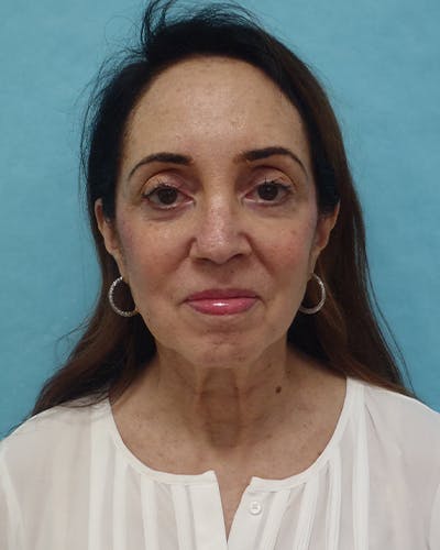 Facelift and Neck Lift Before & After Gallery - Patient 375520 - Image 1