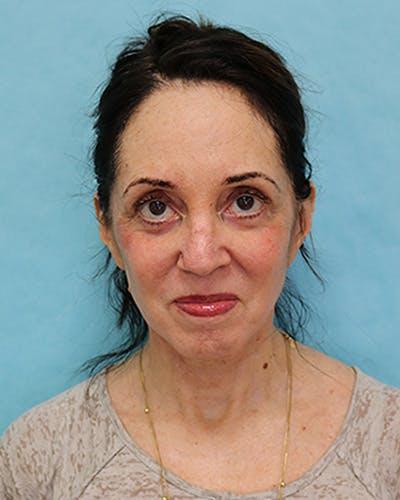 Facelift and Neck Lift Before & After Gallery - Patient 375520 - Image 2