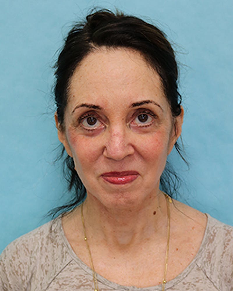 Facelift and Neck Lift Before & After Gallery - Patient 375520 - Image 2