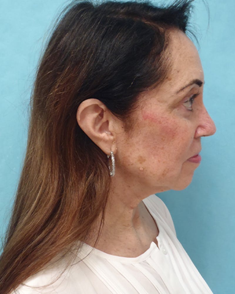 Facelift and Neck Lift Before & After Gallery - Patient 375520 - Image 3