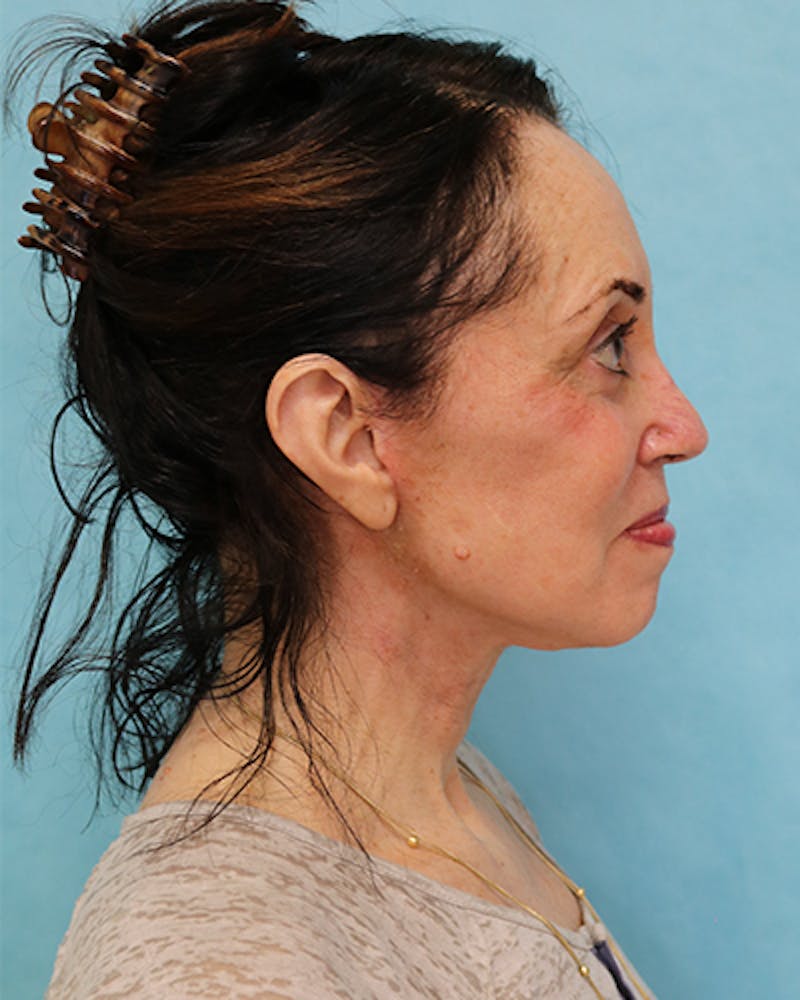 Facelift and Neck Lift Before & After Gallery - Patient 375520 - Image 4