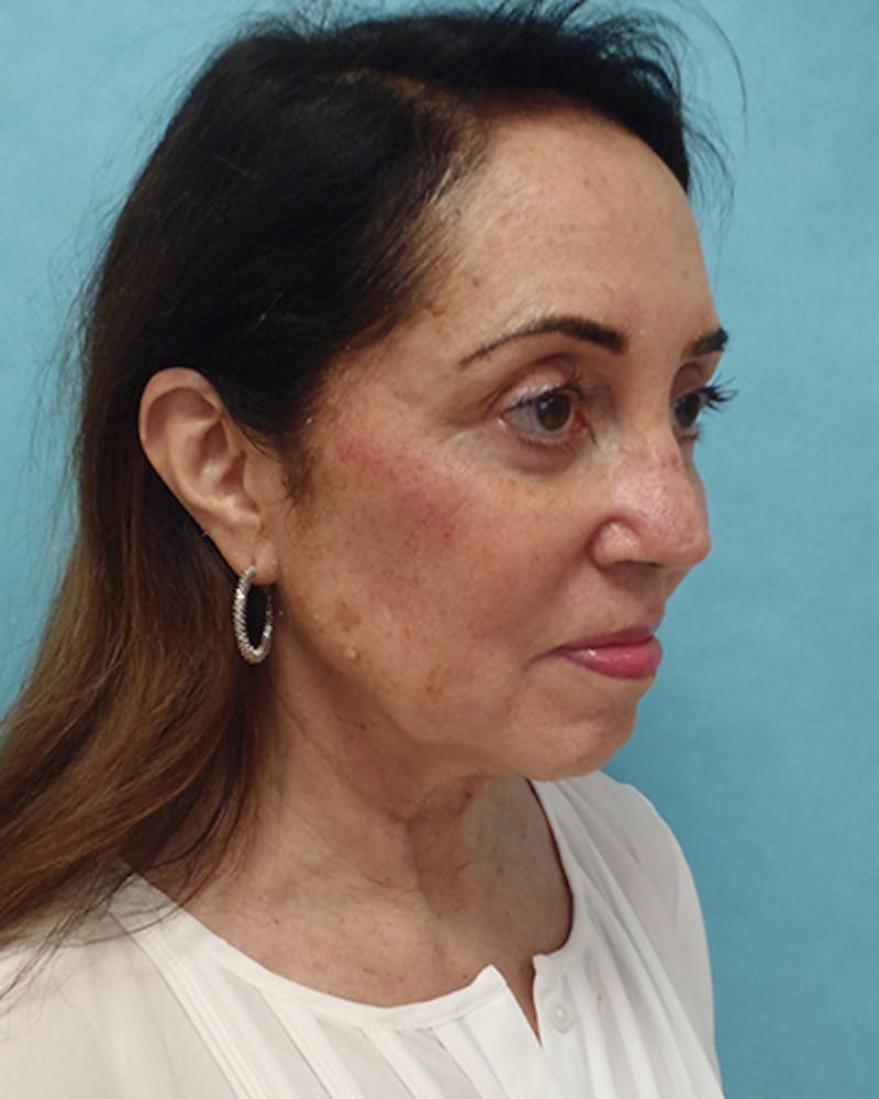 Facelift and Neck Lift Before & After Gallery - Patient 375520 - Image 5