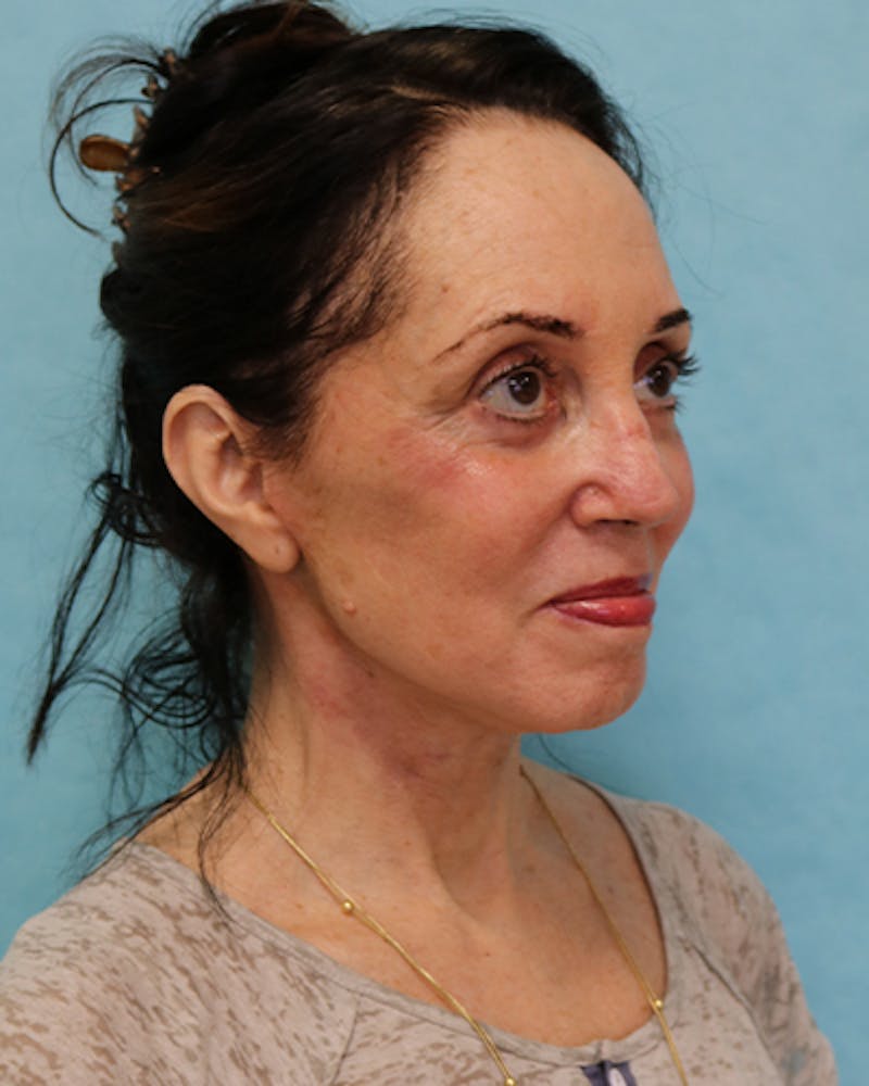Facelift and Neck Lift Before & After Gallery - Patient 375520 - Image 6