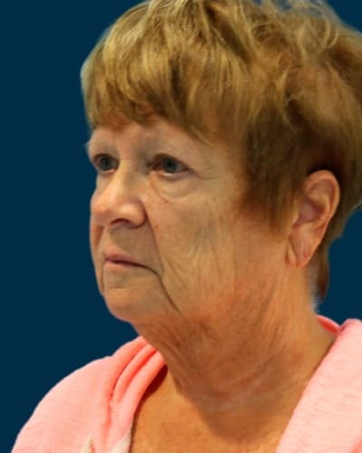 Facelift and Neck Lift Before & After Gallery - Patient 224089 - Image 1