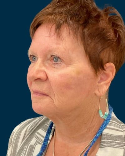 Facelift and Neck Lift Before & After Gallery - Patient 224089 - Image 2
