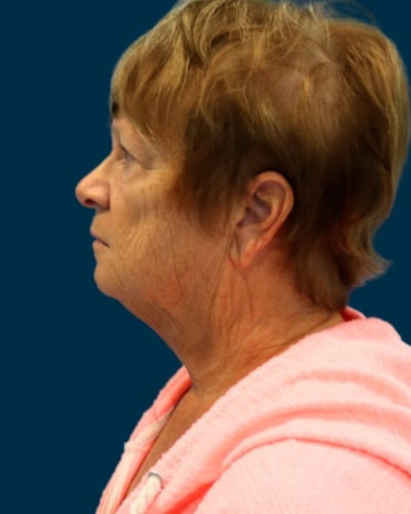 Facelift and Neck Lift Before & After Gallery - Patient 224089 - Image 3