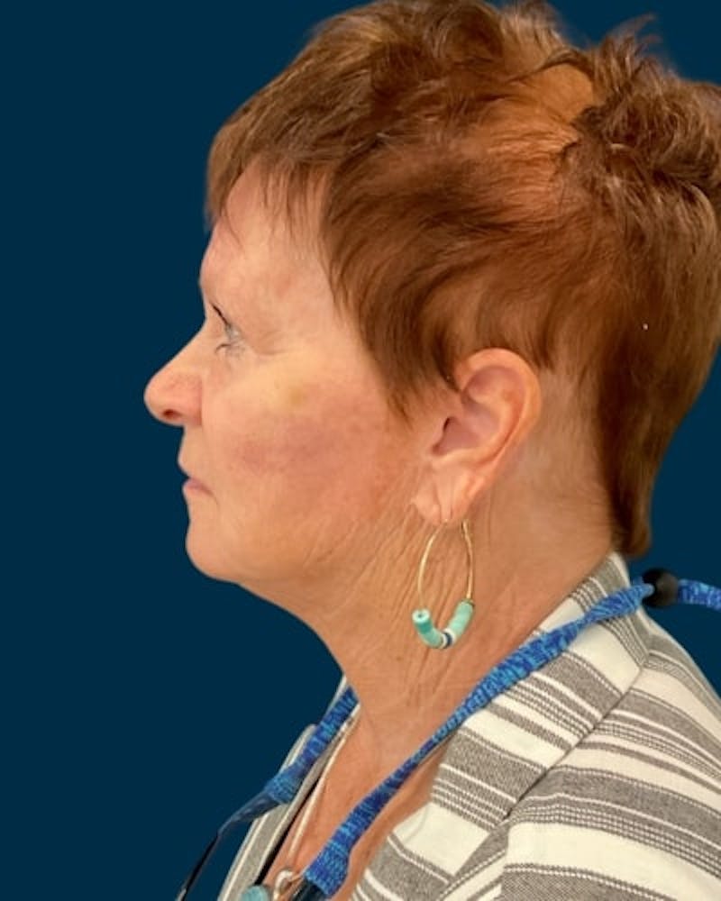 Facelift and Neck Lift Before & After Gallery - Patient 224089 - Image 4