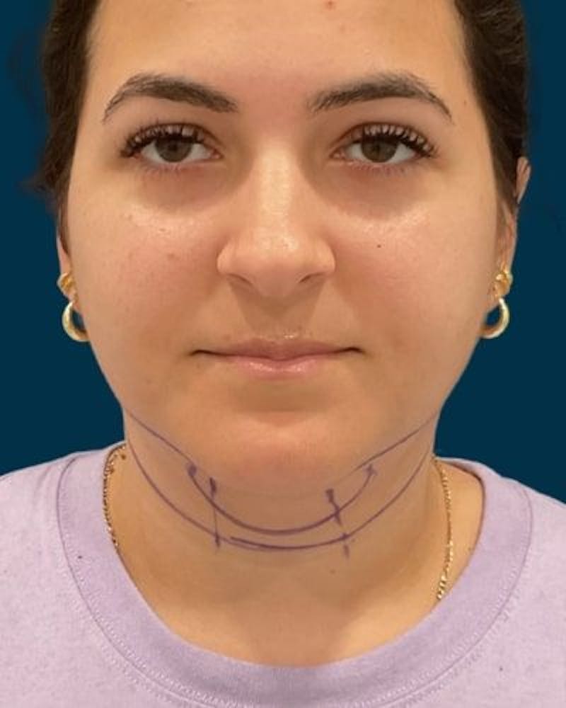 Neck Liposuction Before & After Gallery - Patient 376375 - Image 1