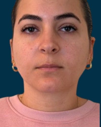 Neck Liposuction Before & After Gallery - Patient 376375 - Image 2