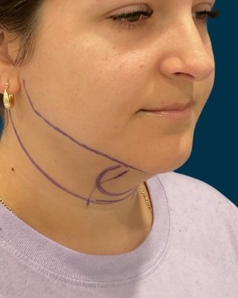 Neck Liposuction Before & After Gallery - Patient 376375 - Image 3
