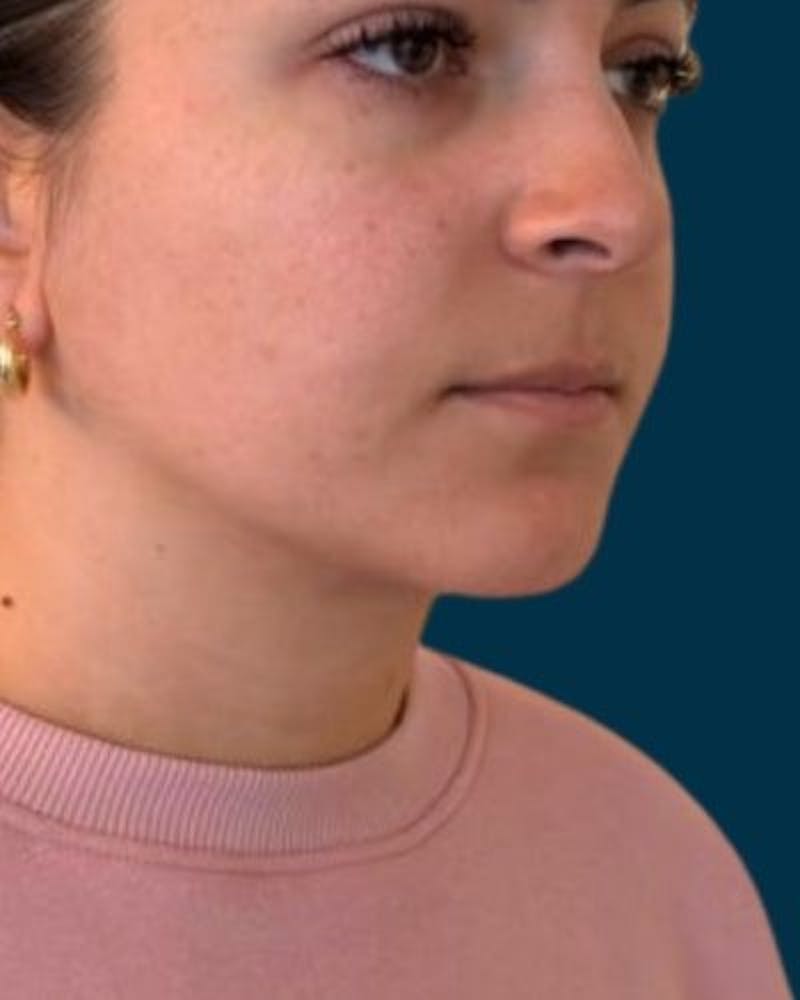 Neck Liposuction Before & After Gallery - Patient 376375 - Image 4