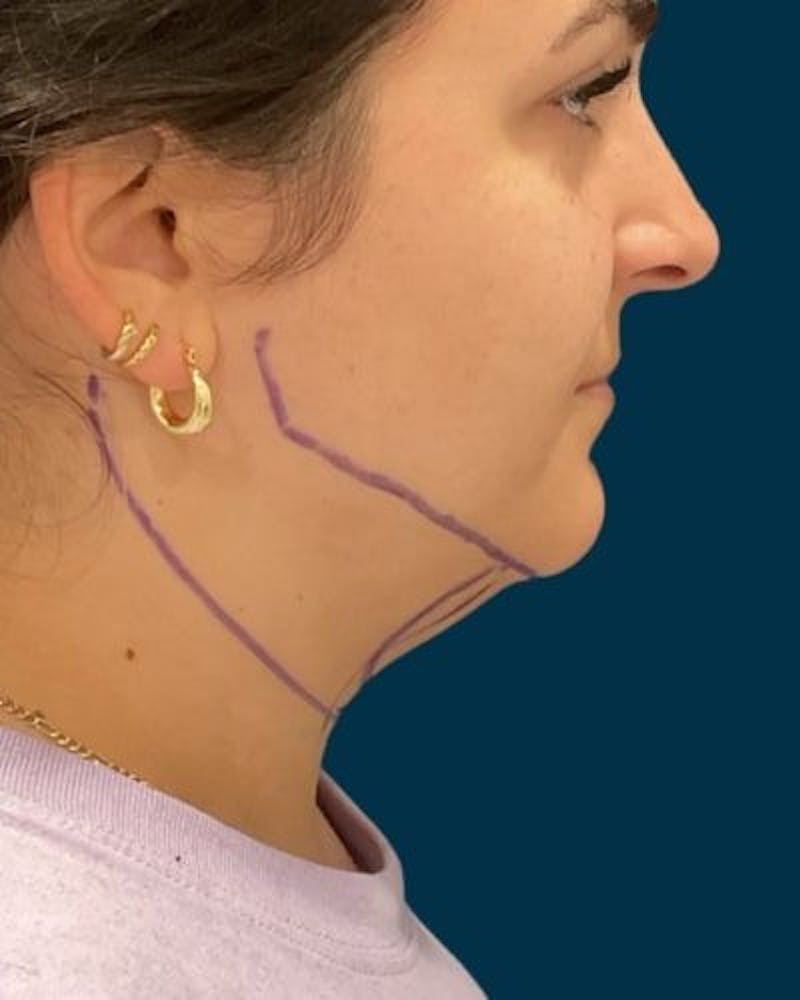 Neck Liposuction Before & After Gallery - Patient 376375 - Image 5