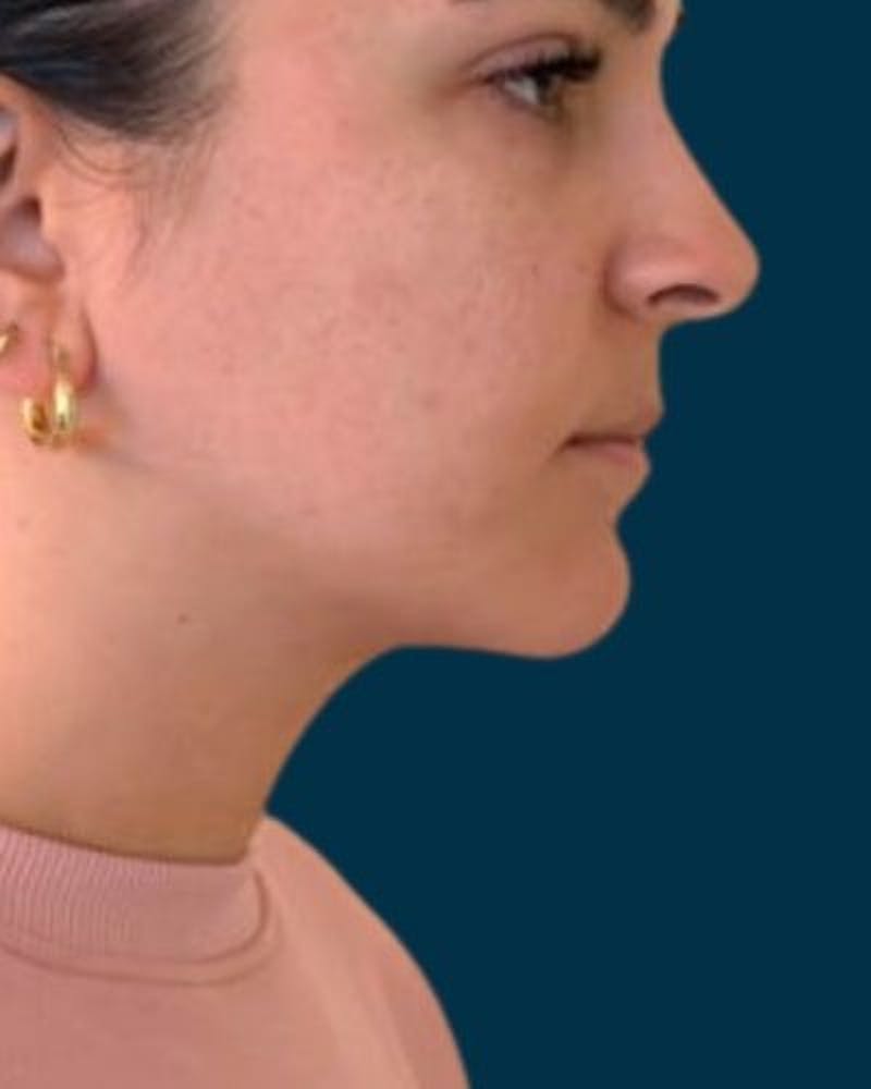 Neck Liposuction Before & After Gallery - Patient 376375 - Image 6