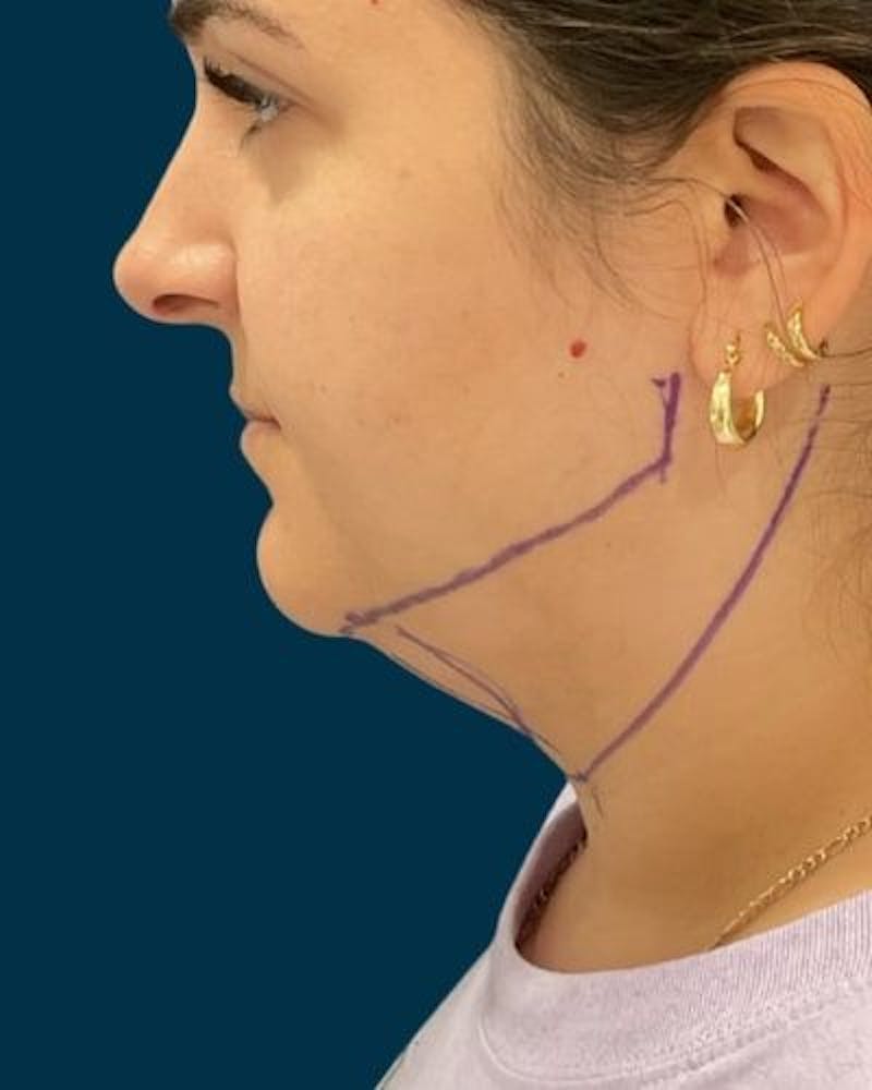 Neck Liposuction Before & After Gallery - Patient 376375 - Image 7