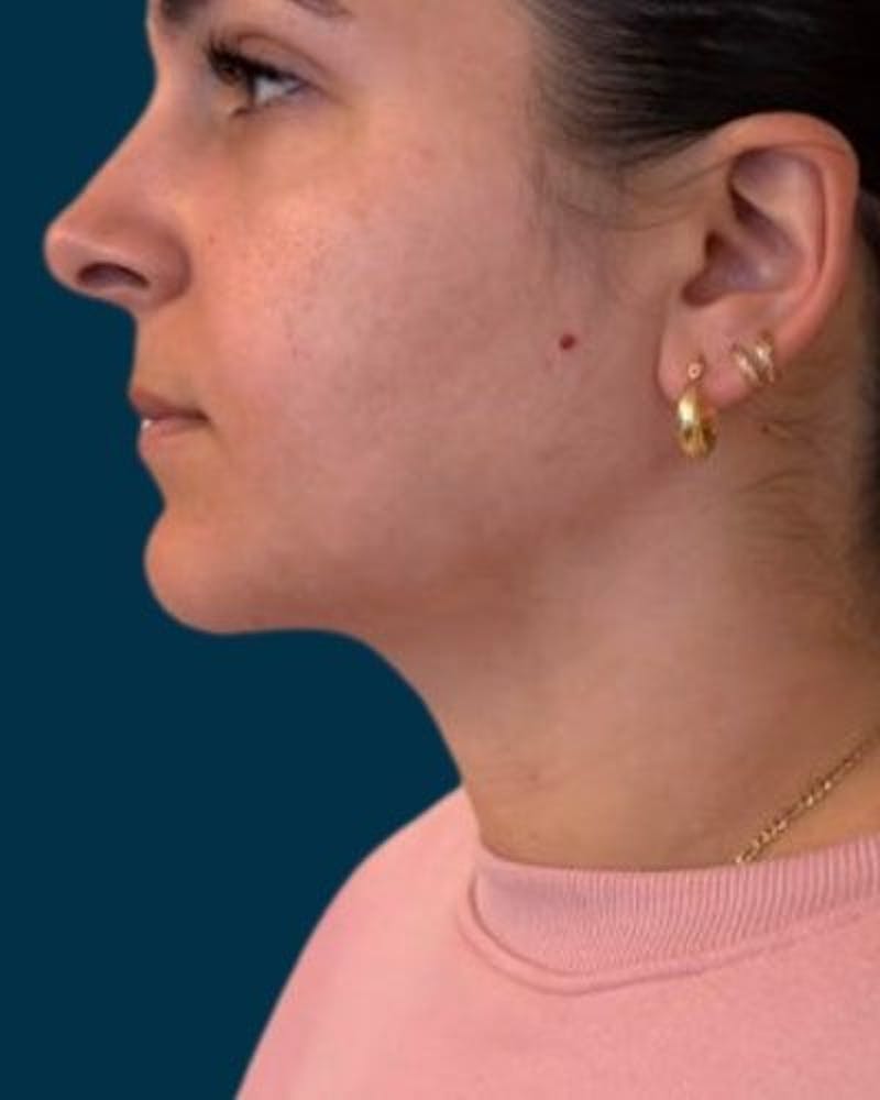 Neck Liposuction Before & After Gallery - Patient 376375 - Image 8