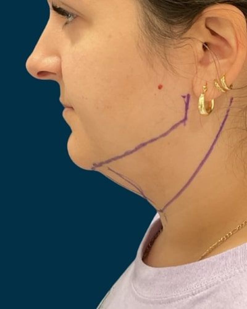Neck Liposuction Before & After Gallery - Patient 376375 - Image 9