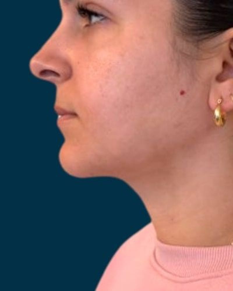 Neck Liposuction Before & After Gallery - Patient 376375 - Image 10