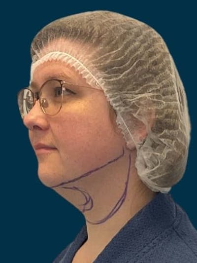Neck Liposuction Before & After Gallery - Patient 136945 - Image 1
