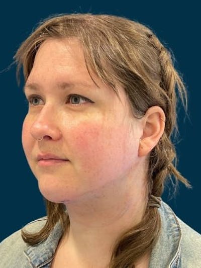 Neck Liposuction Before & After Gallery - Patient 136945 - Image 2