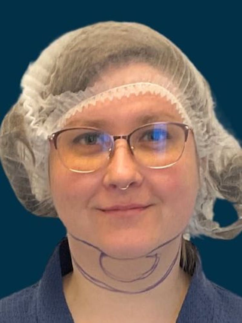 Neck Liposuction Before & After Gallery - Patient 136945 - Image 3