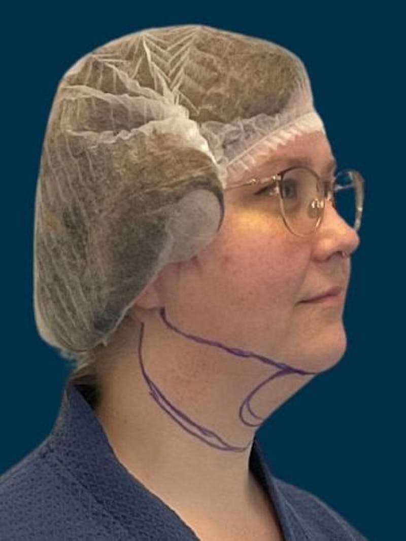 Neck Liposuction Before & After Gallery - Patient 136945 - Image 5