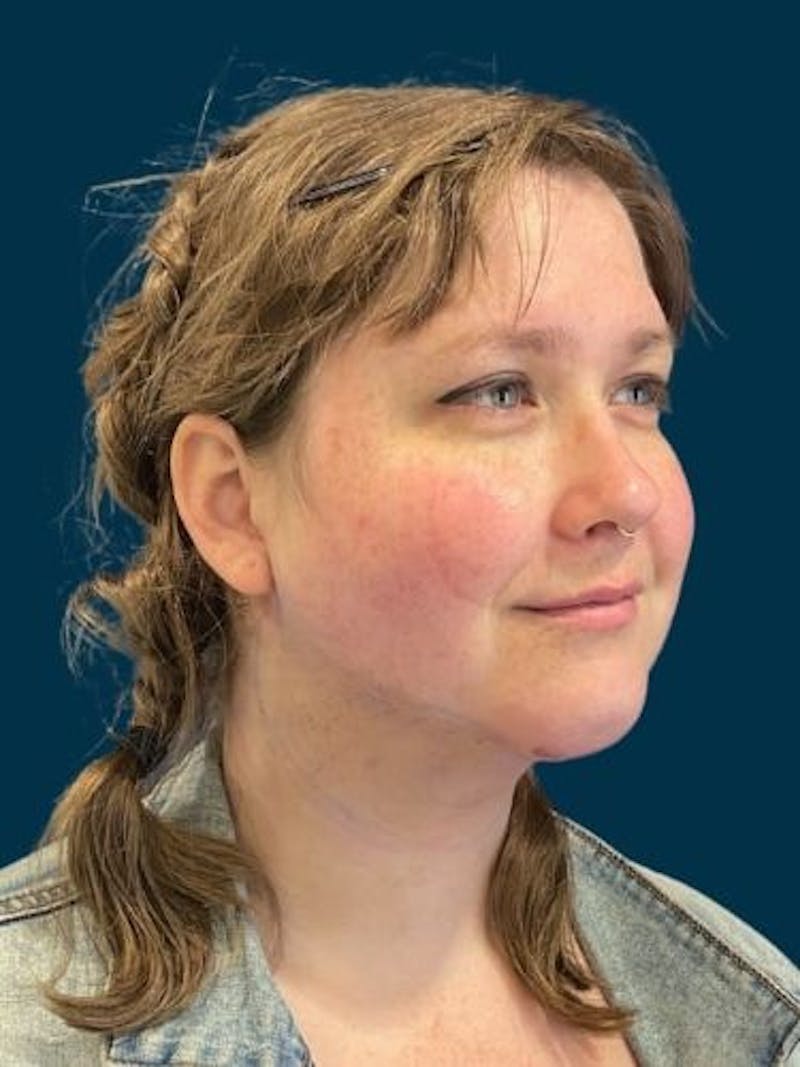 Neck Liposuction Before & After Gallery - Patient 136945 - Image 6