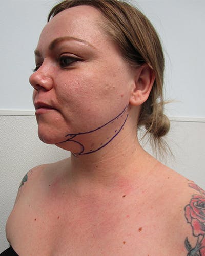 Neck Liposuction Before & After Gallery - Patient 136302 - Image 1