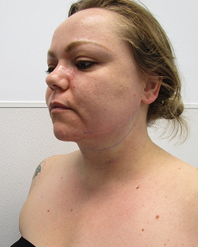 Neck Liposuction Before & After Gallery - Patient 136302 - Image 2