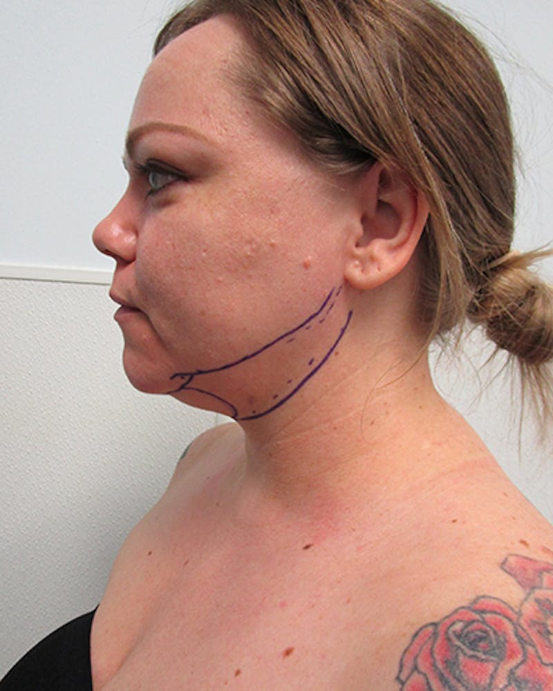 Neck Liposuction Before & After Gallery - Patient 136302 - Image 3