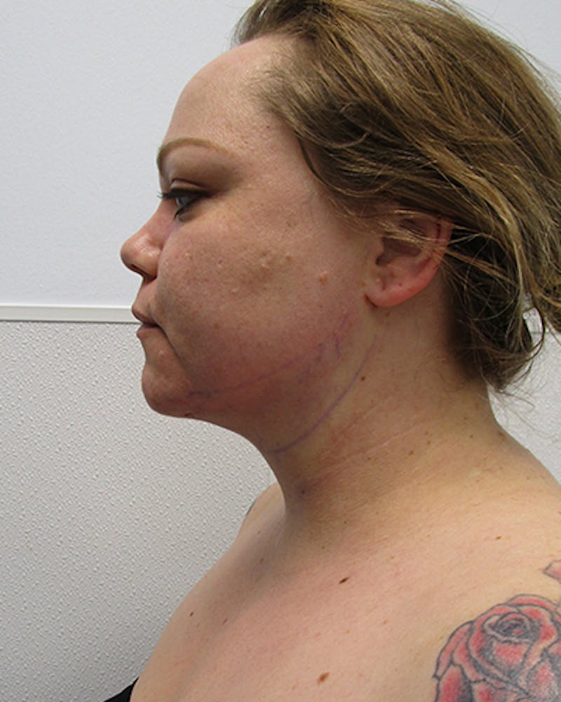 Neck Liposuction Before & After Gallery - Patient 136302 - Image 4