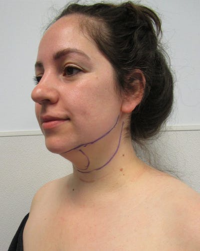 Neck Liposuction Before & After Gallery - Patient 219965 - Image 1